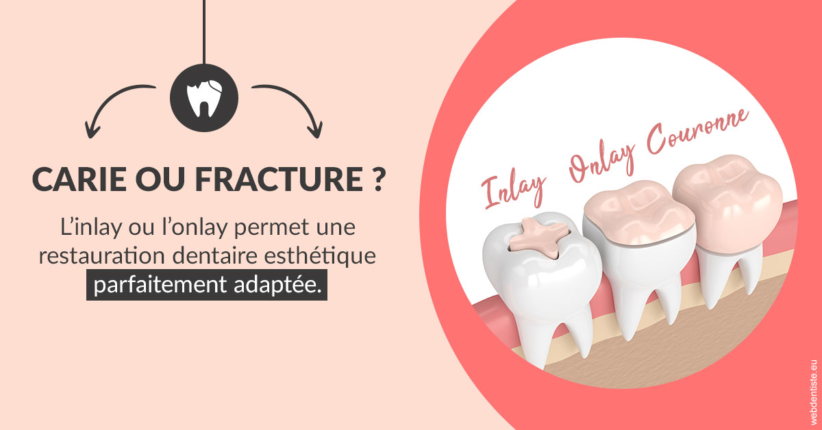 https://dr-jan-patrick.chirurgiens-dentistes.fr/T2 2023 - Carie ou fracture 2