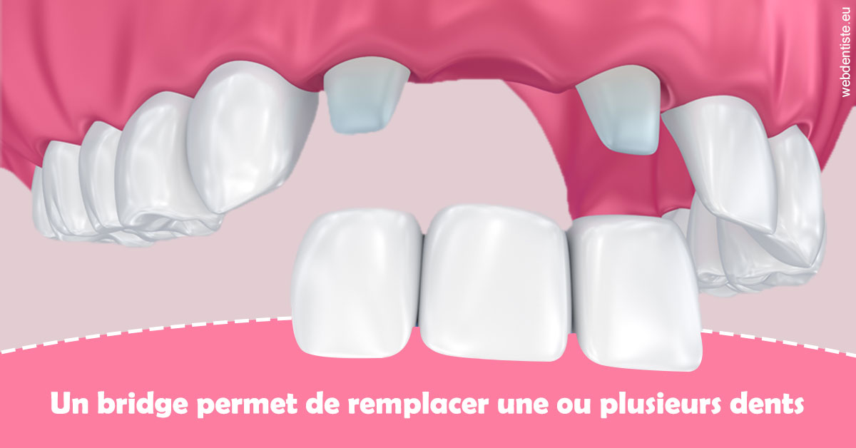 https://dr-jan-patrick.chirurgiens-dentistes.fr/Bridge remplacer dents 2