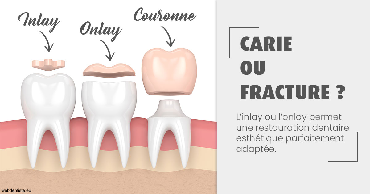 https://dr-jan-patrick.chirurgiens-dentistes.fr/T2 2023 - Carie ou fracture 1