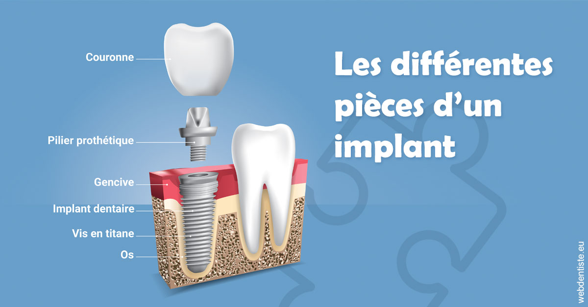 https://dr-jan-patrick.chirurgiens-dentistes.fr/Les différentes pièces d’un implant 1
